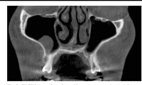 mucus retention cyst floor maxillary sinus