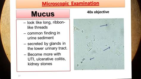 mucus threads in urine meaning