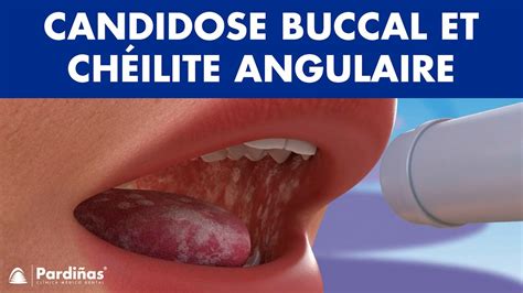 muguet buccal photos