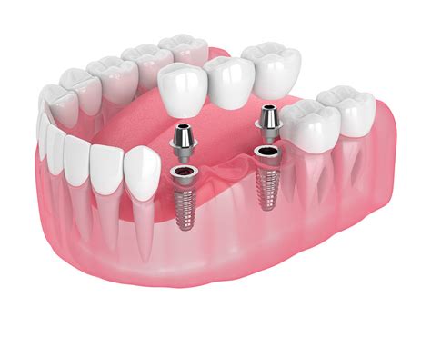 multi tooth dental implants