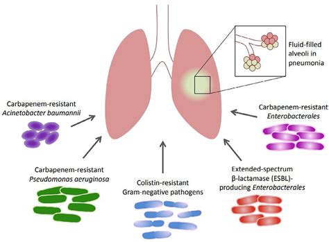 Multidrug-Resistant Pneumonia