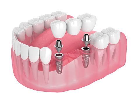 multiple implant dentists ratings