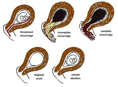 multiple miscarriages in first trimester