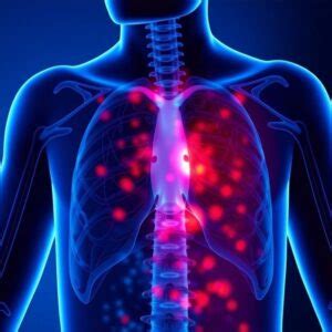 Multiple Myeloma Icd 10