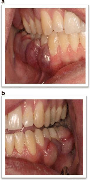 multiple myeloma oral medicine