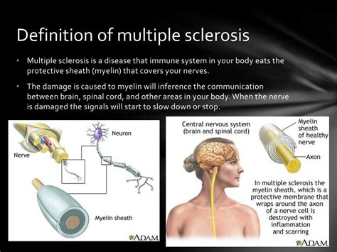 multiple sclerosis definition psychology