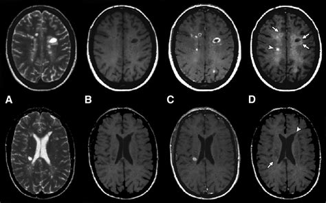 multiple sclerosis mri with or without