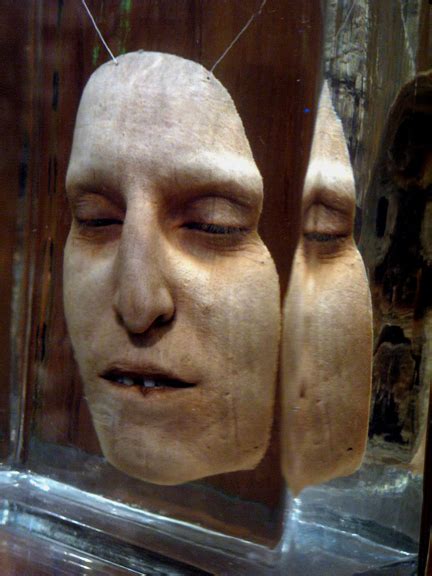 mutter museum largest pimple