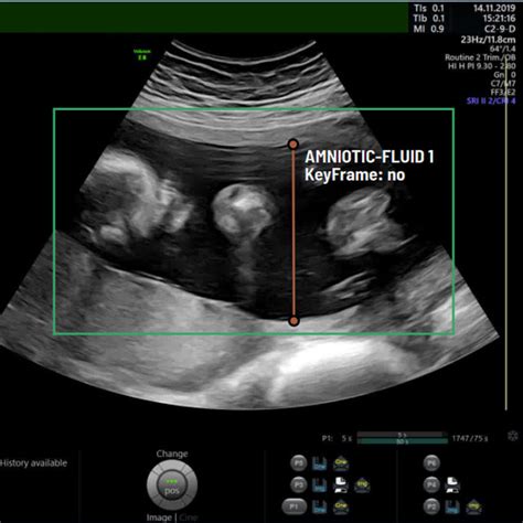 mvp on fetal ultrasound