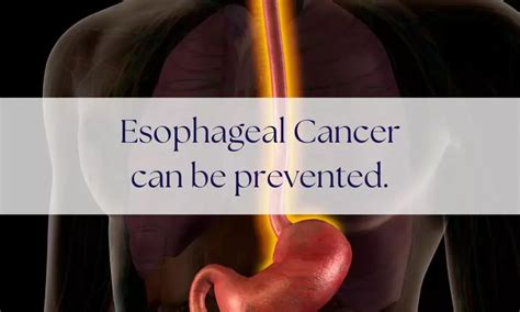 my esophageal cancer story