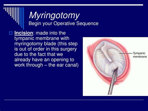 Myringotomy With Grommet Insertion Cpt Code