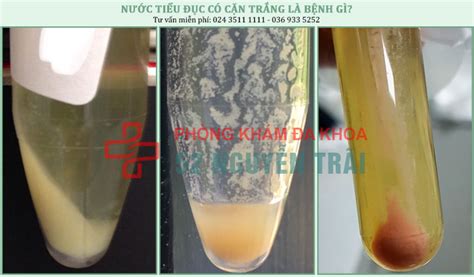 nước tiểu đục trắng