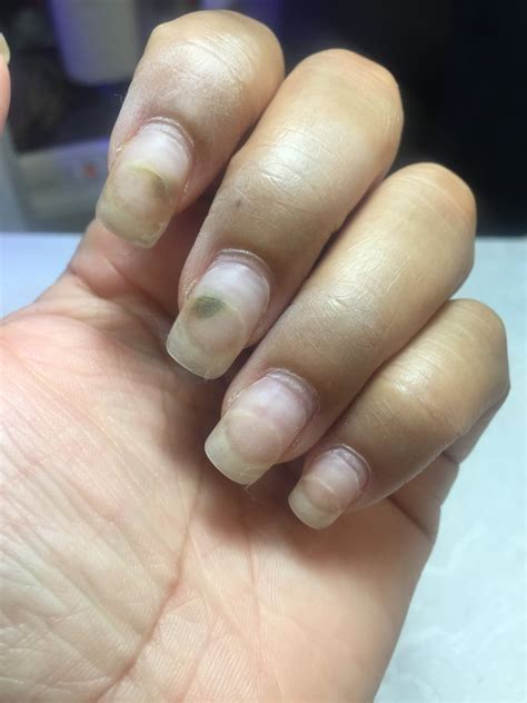 Nail Fungus And Acrylic Nails What Do You Need To Know?
