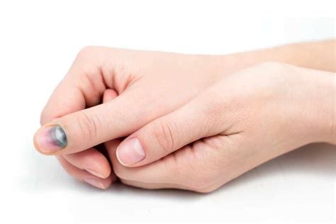 Nail Bed Going Black