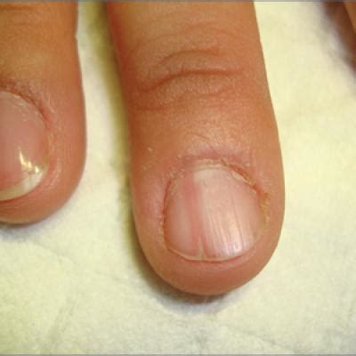 Nail Bed Painful To Touch