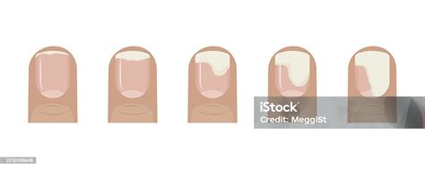 Understanding Nail Bed Separation: Causes, Symptoms, and Treatment Options