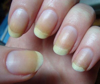 Nail Beds Going Yellow