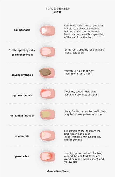 Nail Diseases Chart