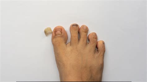 What to Do When a Nail Fell Off: Causes, Prevention, and Aftercare Tips