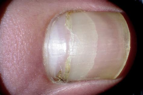Nail Growth Lines
