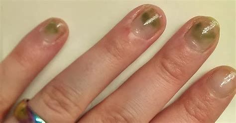 Nail Is Green Under Acrylic