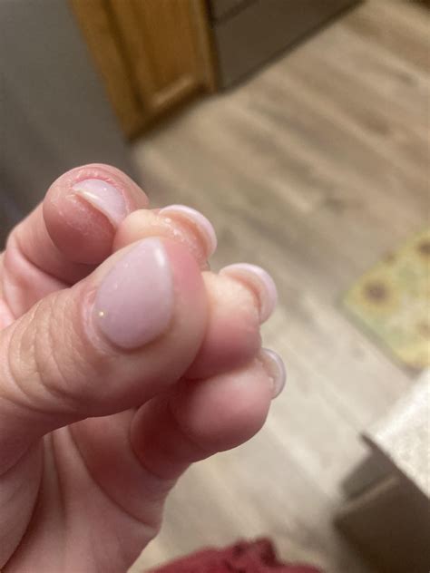 Nail Lifting Reddit
