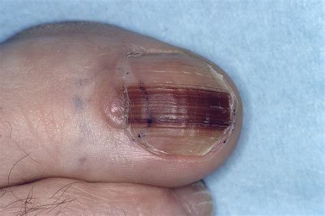 nail melanoma early stages
