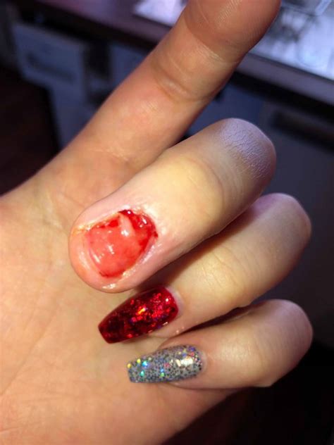 What to Do When a Nail Gets Ripped Off Completely