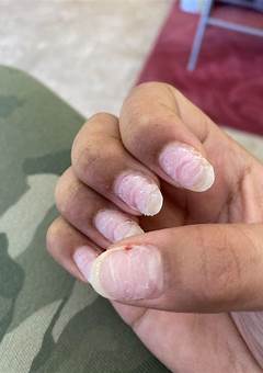 Nails Sore After Acrylic: Causes, Treatment, And Prevention