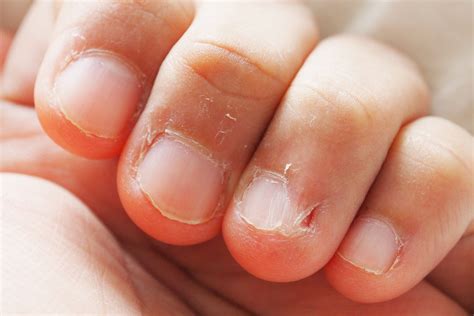 Nails Bite Definition