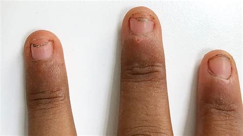 Nails Pulling Up From Skin