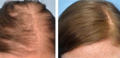 Growth Factors for Hair Loss Miami Stem Cell Hair Treatment