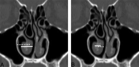 Understanding Nasal Concha Hypertrophy: Causes Symptoms and Solutions