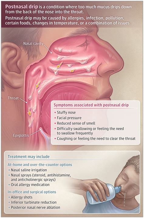 Nasal Drip Vs Strep
