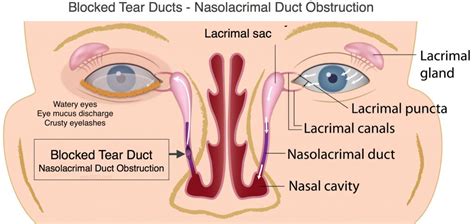Nasal Duct Blockage: Causes, Symptoms, and Effective Treatments Revealed