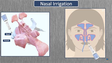 Nasal Irrigation Techniques