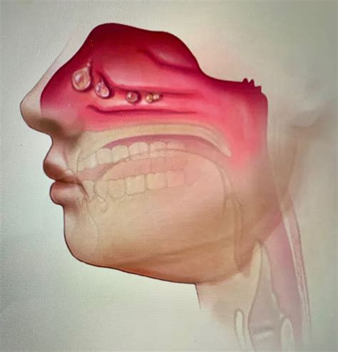 nasal polyposis