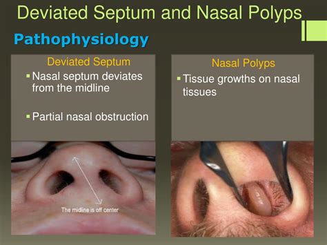 nasal polyps inflammation