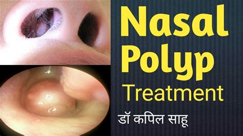 nasal polyps medication