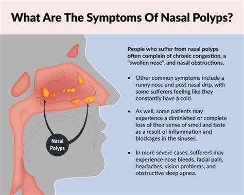 nasal polyps signs