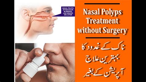 nasal polyps treatment info+manners