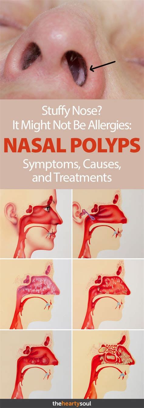 nasal polyps type 2 inflammation relief