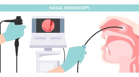 nasendoscopy or nasal endoscopy