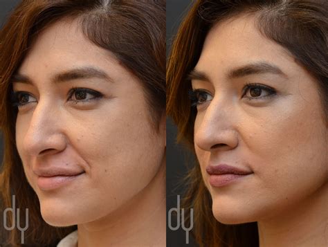 Before and After treating Nasolabial Fold (smile lines) with Juvederm