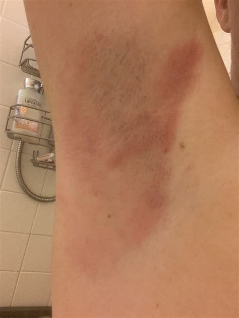 Native Deodorant Burning Armpits