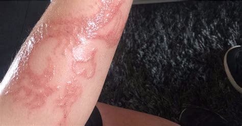 Henna tattoo Allergic reaction leaves boy, 7, with severe