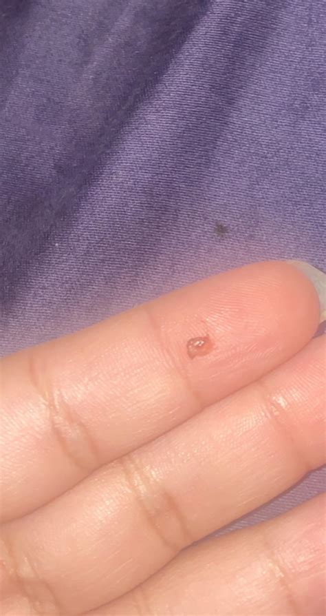 Navel Piercing Tissue Coming Out