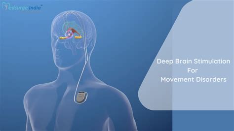Navigation System Deep Brain Stimulation