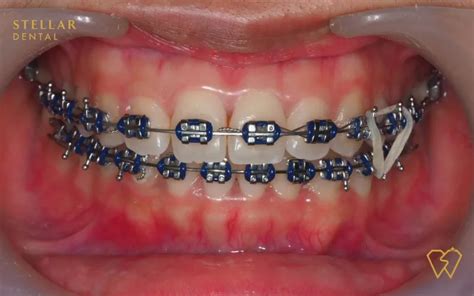 Navy Blue Braces