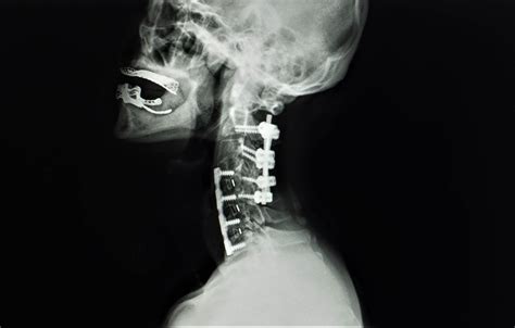 Understanding Neck Fusion Surgery: Is It Right for Your Neck Pain?